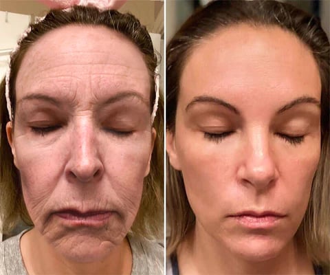 Georgina Before After